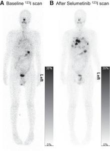 Example of whole-body planar scans at 24 hours after 123I-NaI administration.