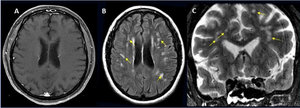 Large International Study Reveals Spectrum of COVID-19 Brain Complications