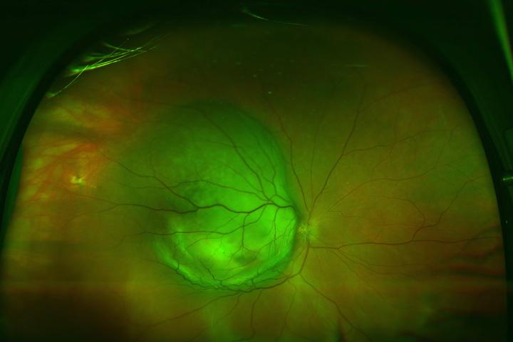 Scientists Identify Weak Point in Deadly Eye Melanoma