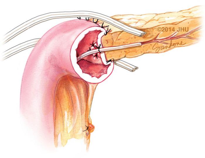 Placement of closed-suction drains at the pancreatico-jejunal anastomosis.