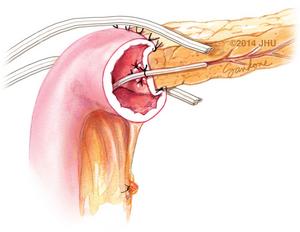 Placement of closed-suction drains at the pancreatico-jejunal anastomosis.