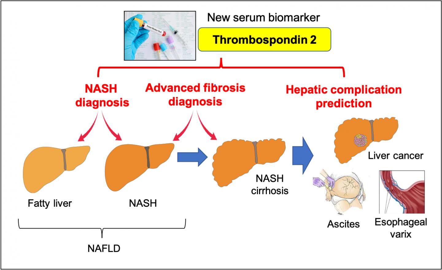 A Simple Blood Test To Identify Patients At Risk Of Nonalcoholic Fatty 