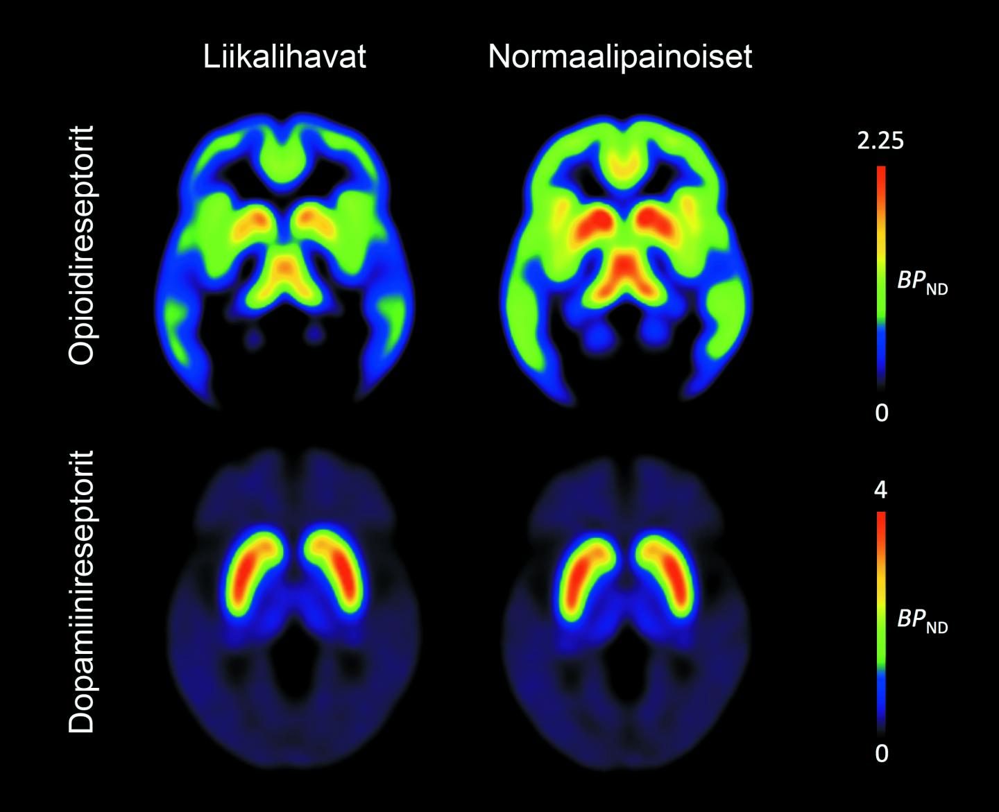 Obesity is Associated with Brain's Neurotransmitters