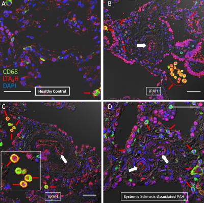 LTB4 Molecule Linked to High Blood Pressure in Heart & Lungs (2 of 3)