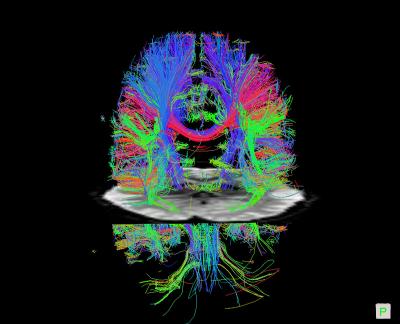 Diffusion MRI Images of Nerve Fibers in the Brain