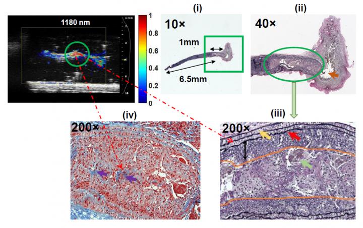 Photoacoustic Imaging Shows Composition of Plaque