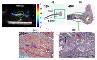 Photoacoustic Imaging Shows Composition of Plaque