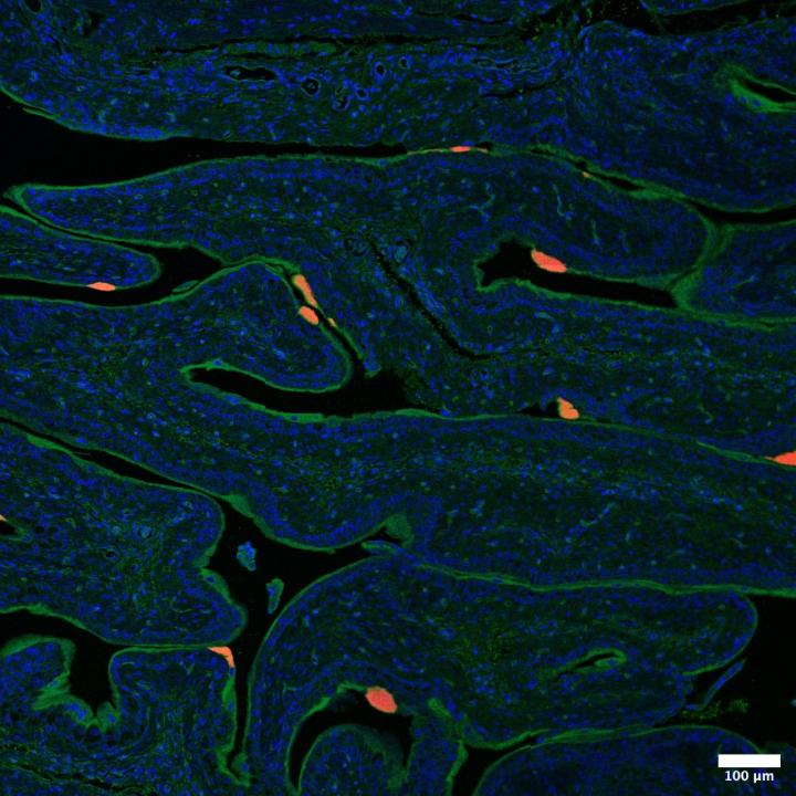 Bacterial toxin is found in patients with urinary tract infections