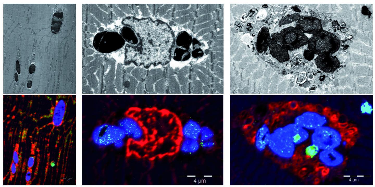 New Muscular Disease: Myoglobinopathy