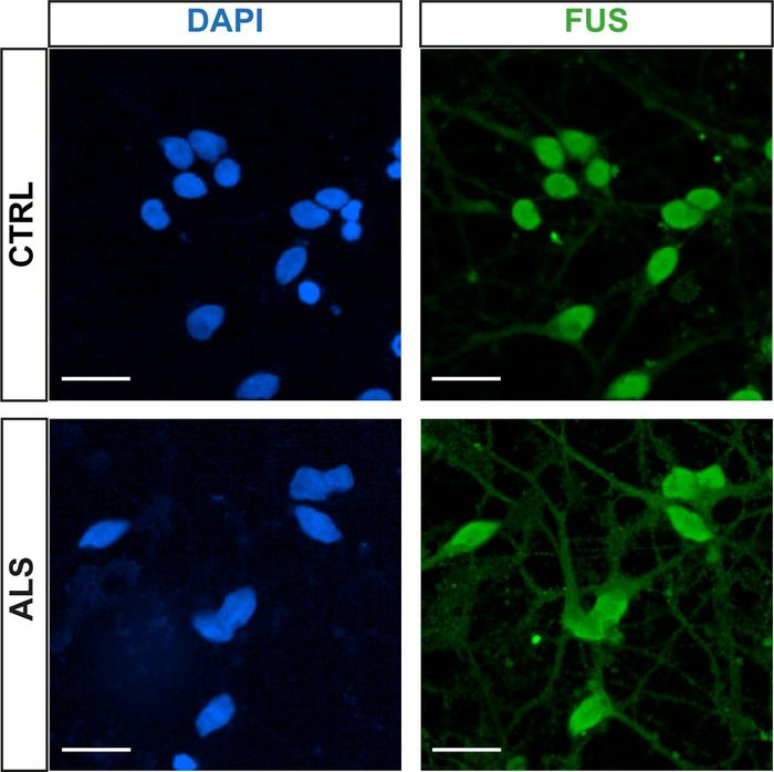 Fluorescent images showing protein movement out of the nucleus into the cytoplasm in cells with ALS mutations.