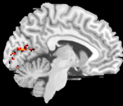 MRI of Nonpreferred Retinal Location