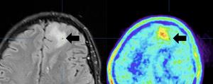 Brain images obtained using MRI and a new tyrosine PET procedure