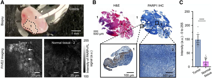 PARPi-FL imaging of a clitoral excision – invasion from a vulvar squamous cell carcinoma.