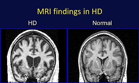 MRI of HD Brain