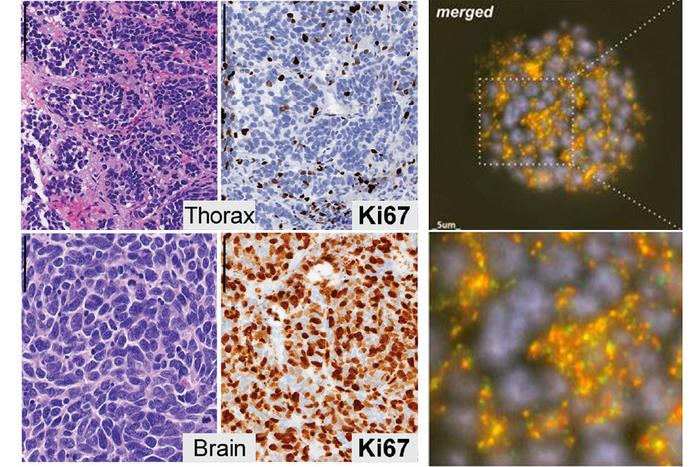 Atypical Small Cell Lung Cancer Science Images