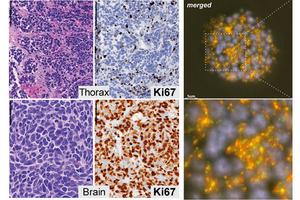 Atypical Small Cell Lung Cancer Science Images