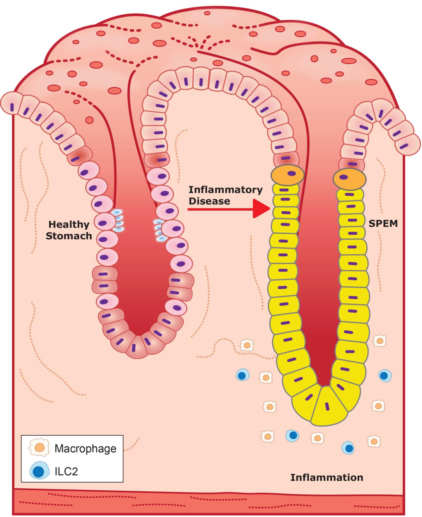 Healthy and Diseased Stomach Glands