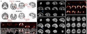 Ultra-High-Resolution PET Provides Never Before Seen Images of the Brain