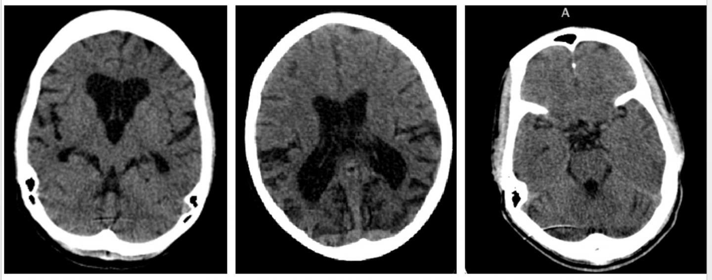 Scans of Post-Ebola affected brains