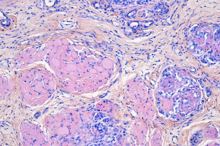 AMYLOID DEPOSITS IN CANINE MAMMARY GLAND TUMOR