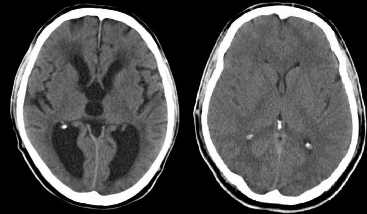 CT of Patient with Hydrocephalus