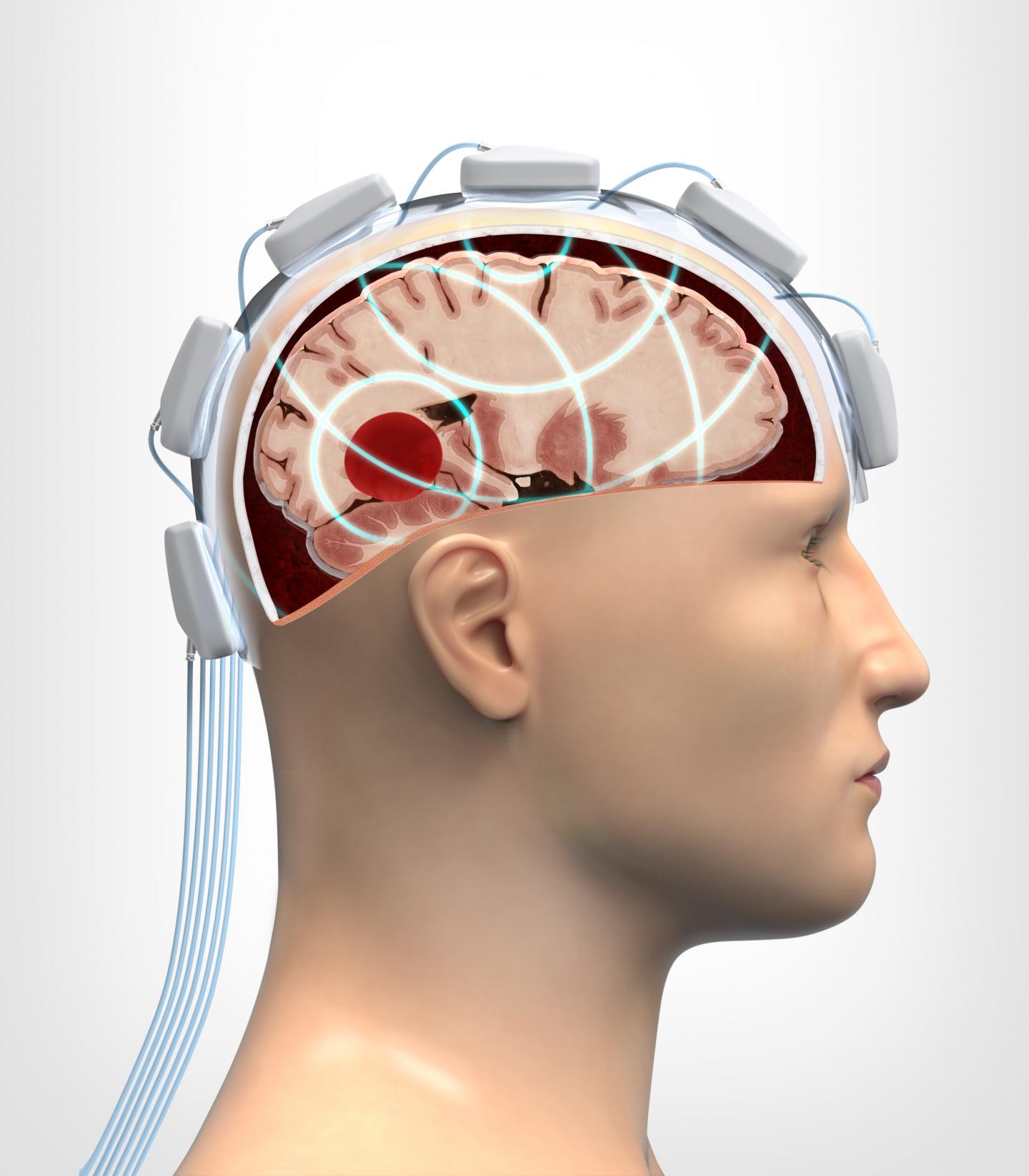 Microwave Helmet Yields Fast and Safe Evaluation of Head Injuries