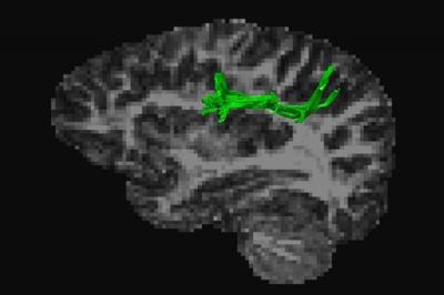 Arcuate Fasciculus Anterior