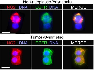 NG2+ Cell Pairs from Tumor and Non-neoplastic Tissue