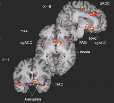 Brain response to placebo