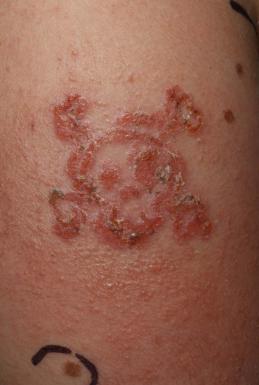 Outline of Black Henna Tattoo with Surrounding Soft Tissue Inflammation