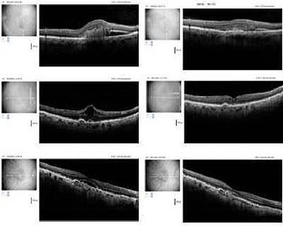 Ocular Coherence Tomography Digital Images