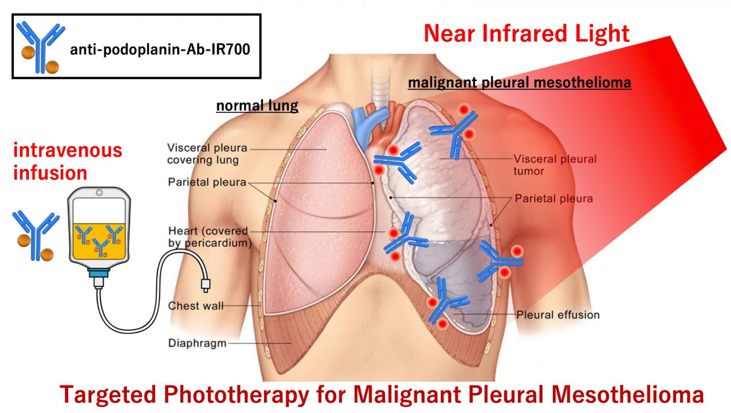 Targeted Phototherapy for Malignant Pleural Mesothelioma