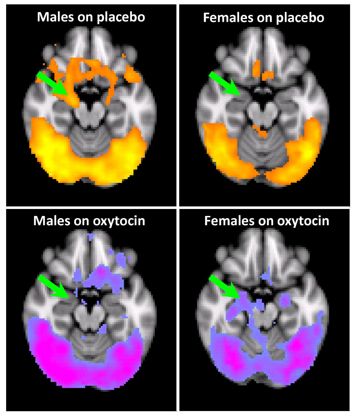 Brain Activation to Pictures Related to Cocaine Use in Male and Female Cocaine Users with History of