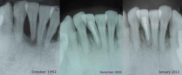 Image of X-rays Showing Severe Periodontitis