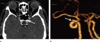 AI Helps Detect Brain Aneurysms on CT Angiography - Figure 2