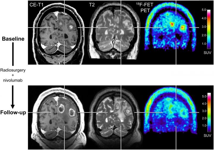 Metabolic activity pre- and post-treatment measured with PET