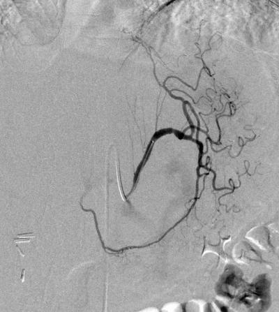 Left Gastric Artery Angiography