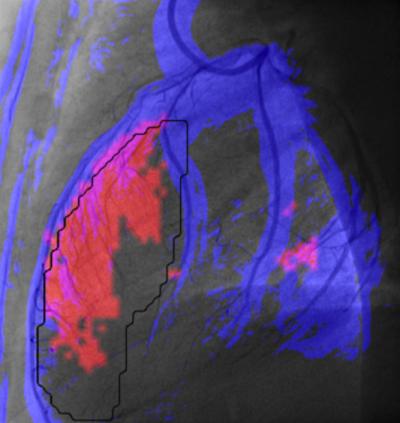 New Tool to Improve and Speed up Diagnosis of Heart Damage after a Heart Attack