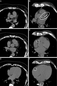 Axial noncontrast CT scans in participants with/without coronary artery calcium.