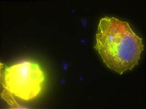 Immunofluorescence of breast cancer cells treated with a MicroQuin therapeutic