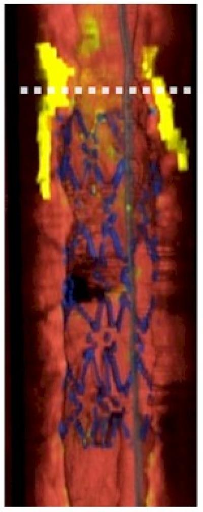 Technology Gives 3-D View of Human Coronary Arteries (1 of 2)