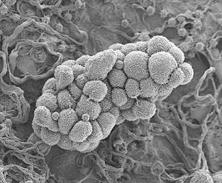 Ovarian Cancer Cells