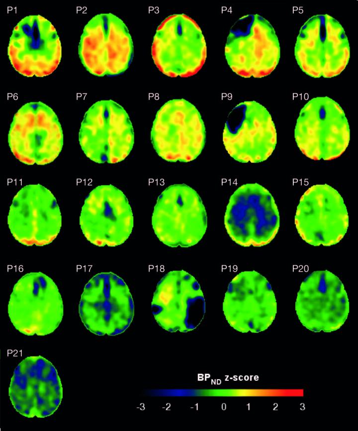 Single Traumatic Brain Injury Can Have Long-Term Consequences for Cognition (1 of 1)