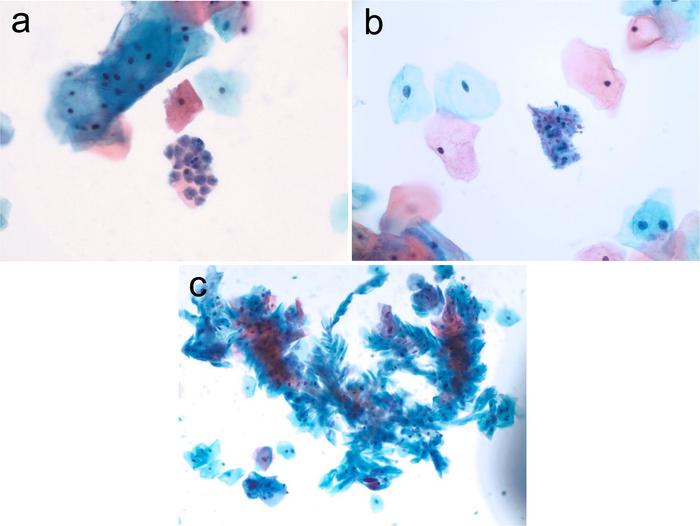 Infection showing the hyphae with “shish kabob” cytomorphologic features