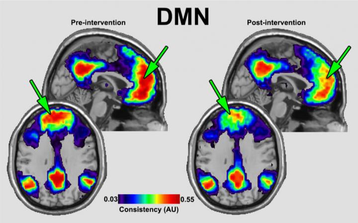fMRI image of Default Mode Network (DMN)