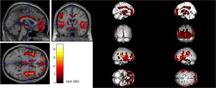 PET scan of a patient with iNPH. The imaging showed that focal decrease in metabolism in the bilateral medial, cingulate gyrus, parietal, insular, and caudate nuclei, bilateral thalamus, and midbrain, especially bilateral ventricles and the peripheral thi