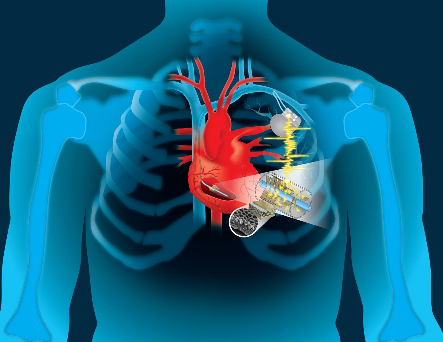 Dartmouth Engineers Device to Capture Cardiac Energy