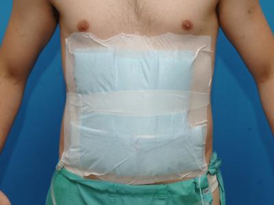 Patient After Abdominal Surgery