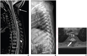 16-Month-Old Boy, Born at Gestational Age of 28 Weeks, Presenting With Unexplained Facial Burns