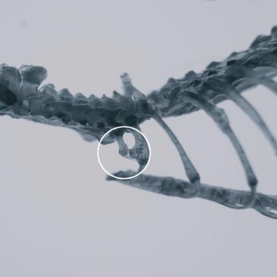 Transformation of the Seventh Cervical Vertebra Into a Thoracic Vertebra